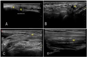 Ultrasound-guided scalp block combined with dexmedetomidine for pain ...